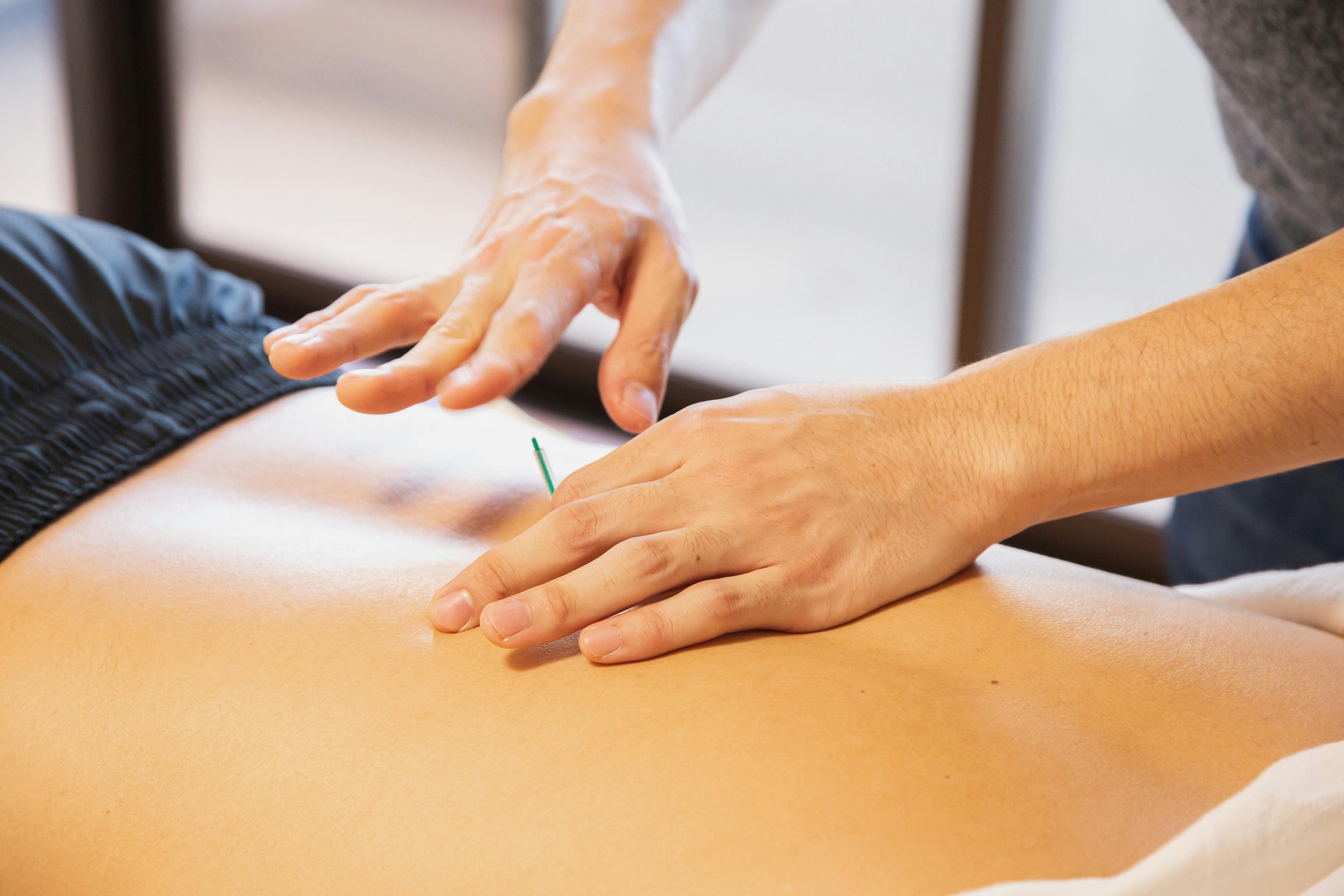 Person receiving acupuncture treatment on their back, with a practitioner inserting a thin acupuncture needle.